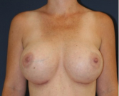 Feel Beautiful - Breast Revision with Augmentation 410 - After Photo